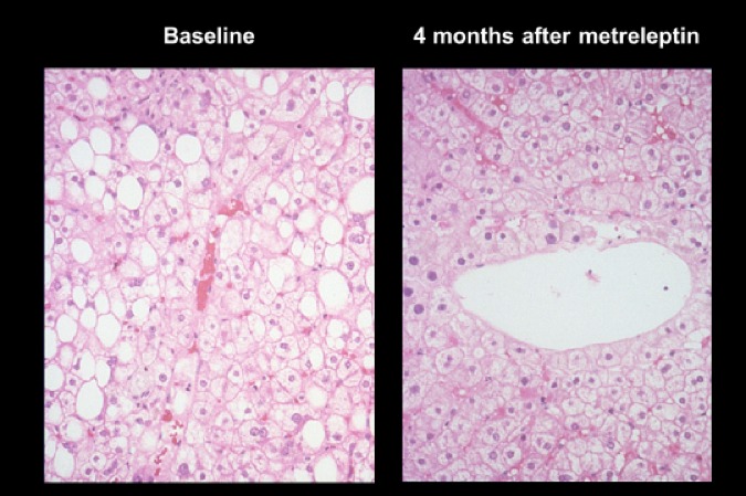Figure 17. Liver histology shows regression of hepatic steatosis and ballooning injury after metreleptin treatment (left before metreleptin and right 4 months on metreleptin treatment, Hematoxylin and eosin staining; magnification 200X).