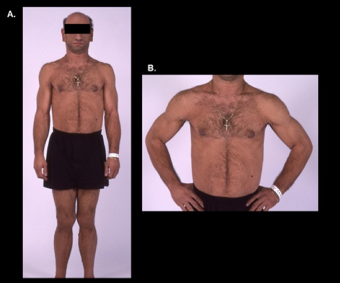 Figure 3. Near total absence of adipose tissue in a patient with CGL2 (3A, 3B).