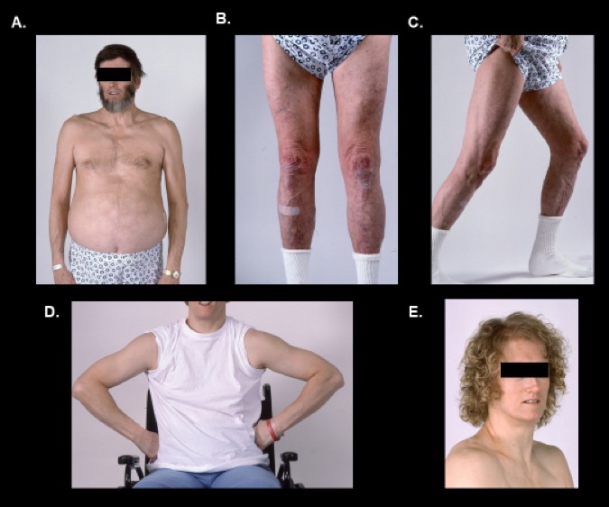 Figure 4. Partial lipodystrophy associated with heterozygous CAV1 frameshift mutations in a male (4A, 4B, 4C) and female subject (4D, 4E).