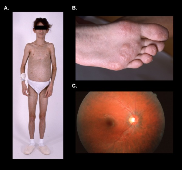 Figure 6. Generalized lack of subcutaneous fat (6A), eruptive xanthomata (6B), and lipemia retinalis (6C) secondary to severe hypertriglyceridemia in a patient with heterozygous LMNA p.