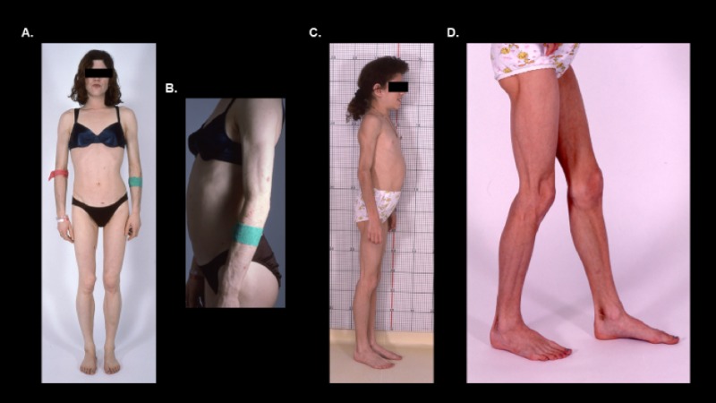 Figure 7. Generalized loss of subcutaneous fat in two patients with AGL (7A-D).