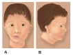 Figure 3. . (A) Frontal and (B) lateral views of a boy with right-sided microtia, preauricular tag, macrostomia, and mandibular hypoplasia with soft tissue deficiency.