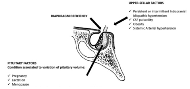 Figure 1. . Factors involved in pathogenesis of primary empty sella including the upper-sellar factors, incompetence or incomplete formation of the sellar diaphragm, and pituitary factors associated with the variation in the pituitary volume.