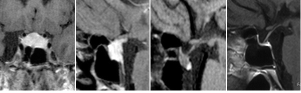 Figure 3. . Contrast enhanced coronal and sagittal T1W images of lymphocytic hypophysitis spontaneous evolution from the presentation (panel A, B), after 4 (panel C) and 10 years (panel D) of follow-up resulting in secondary empty sella.