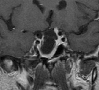 Figure 4. . Coronal T1W images demonstrating a pituitary tumor (macroprolactinoma) shrinkage in a patient treated with the dopamine agonist cabergoline for 10 years.