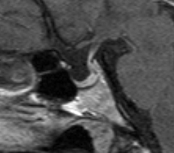 Figure 6. . Sagittal T1W images of pituitary stalk pressed against the dorsum sellae causing mild hyperprolactinemia in a patient with primary empty sella.