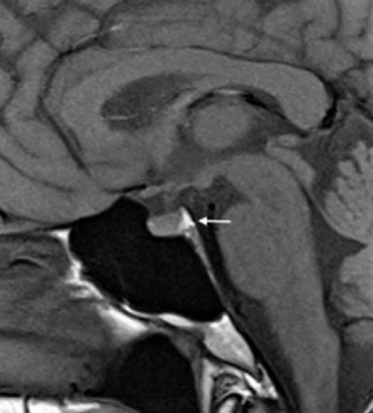 Figure 5. . Magnetic resonance imaging (MRI) of the pituitary gland.