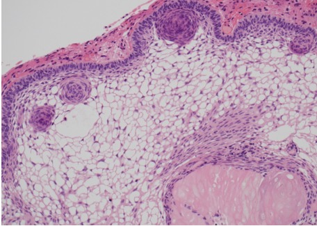 Figure 1B. . Histology of adamantinomatous craniopharyngioma.