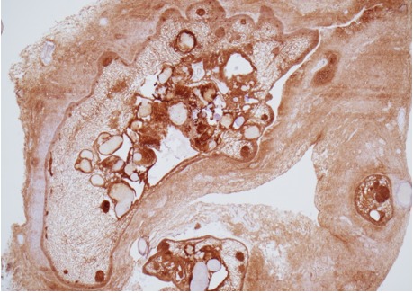Figure 1C. . Histology of adamantinomatous craniopharyngioma.