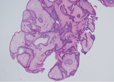 Figure 2A. . Histology of papillary craniopharyngioma.