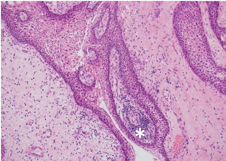 Figure 2B. . Histology of papillary craniopharyngioma.