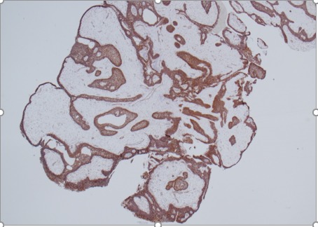 Figure 2C. . Histology of papillary craniopharyngioma.