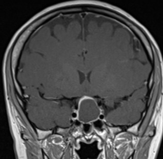 Figure 3A. . MRI images of craniopharyngiomas.