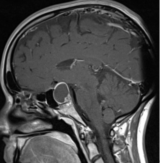 Figure 3B. . MRI images of craniopharyngiomas.