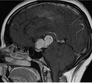Figure 3C. . MRI images of craniopharyngiomas.