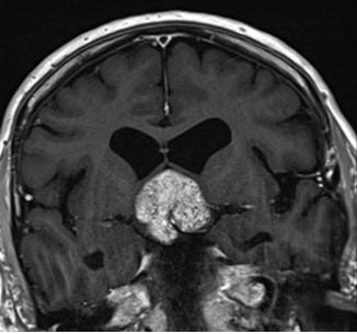 Figure 3D. . MRI images of craniopharyngiomas.