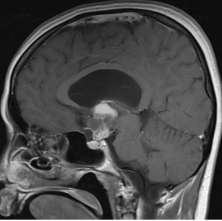 Figure 3E. . MRI images of craniopharyngiomas.