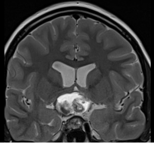 Figure 3F. . MRI images of craniopharyngiomas.
