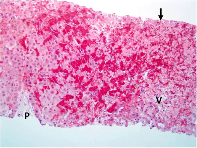 Sinusoidal Obstruction Syndrome: This biopsy was taken from a 48 year old man who developed signs of sinusoidal obstruction syndrome following bone marrow transplantation. There is congestion and hemorrhage in zone 3 with spillage of red blood cells in between hepatocytes. This change is associated with hepatocyte necrosis (arrow). The central vein is not clearly seen, but the location is indicated (V). The portal area (P) is also marked for reference.