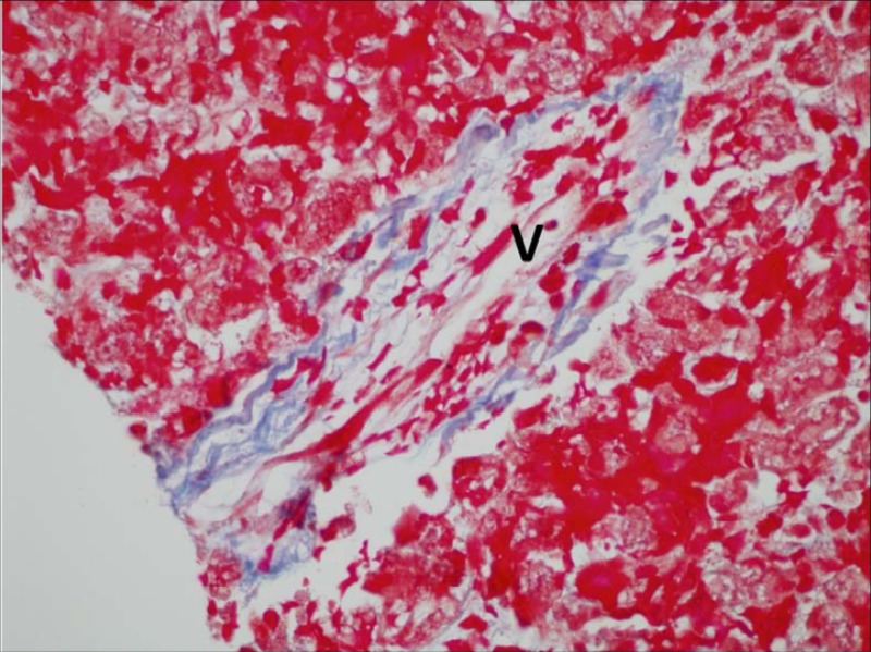 Sinusoidal Obstruction Syndrome: On a Masson trichrome stain, the distinction between the original vein wall (stained blue) and the red colored strands of collagen within the vein lumen (V). In this section, the vessel lumen is almost completely occluded.