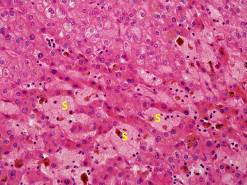 Oxaliplatin Injury: In the areas showing sinusoidal dilation the sinuses are congested and the hepatocyte plates are narrowed. Note that in this preparation, the red blood cells are pale pink rather than bright red. The cells containing brown pigment are macrophages loaded with iron.