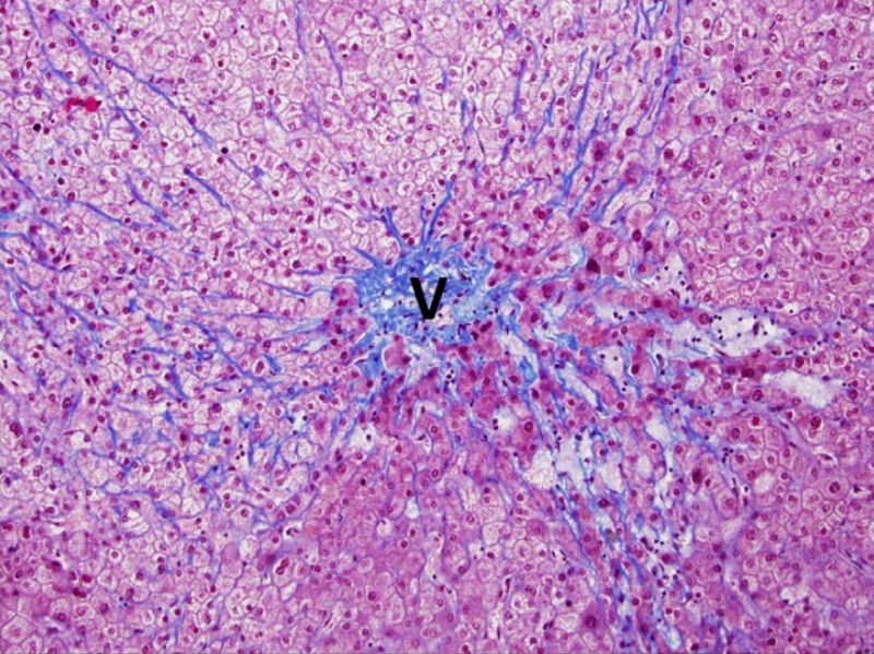 Oxaliplatin Injury: The Masson trichrome stain shows delicate perisinusoidal fibrosis (blue stain), particularly in the areas of sinusoidal dilation. In the center of the photo there is a blue stained scar that probably represents a scarred and occluded vein (V)