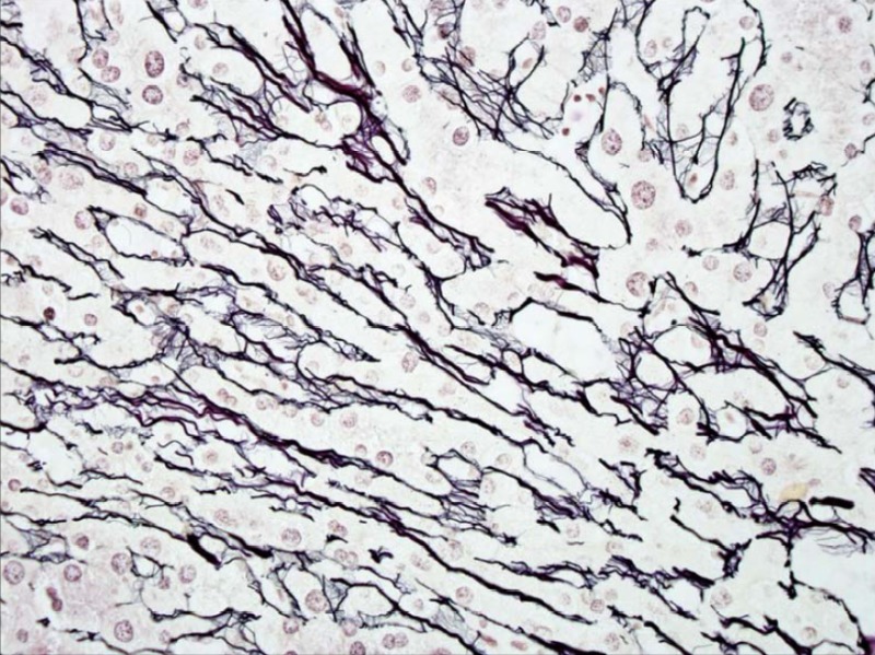 Oxaliplatin Injury: The liver cell plates at the edge of the nodule are one hepatocyte wide, but the hepatocytes are narrower than normal.