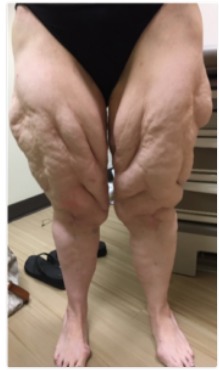 Figure 4. . Fat due to obesity and fat due to lipedema can be intermixed on the legs.