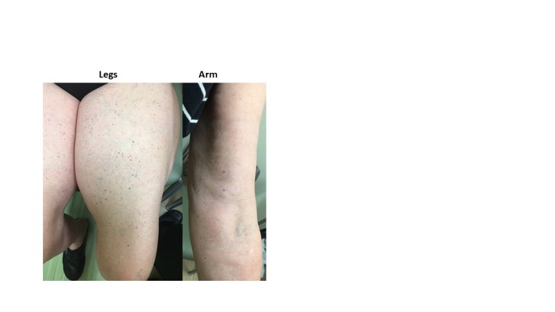 Figure 7. . Multiple cherry angiomas present on the legs and arms of a woman with angiolipomatosis.
