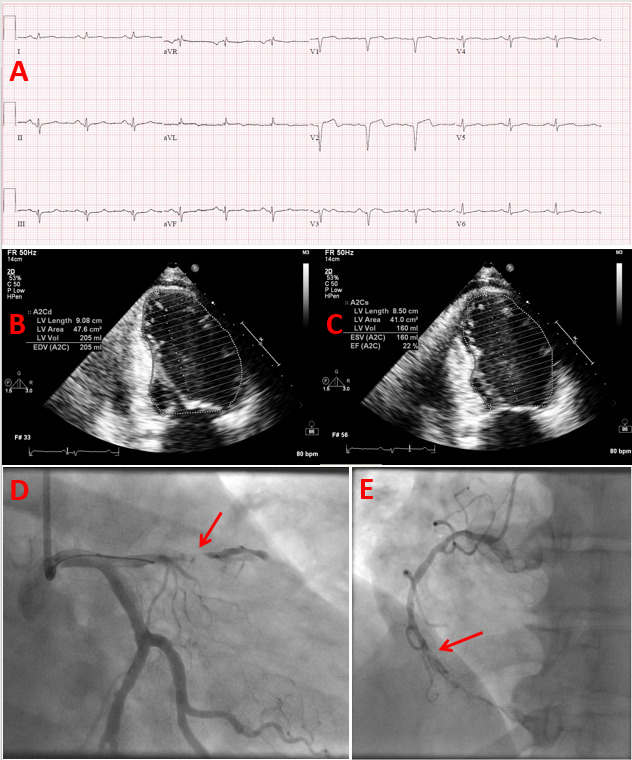 Figure 1. . Heart failure with reduced ejection fraction due to ischemic cardiomyopathy in a patient with uncontrolled type 2 diabetes.