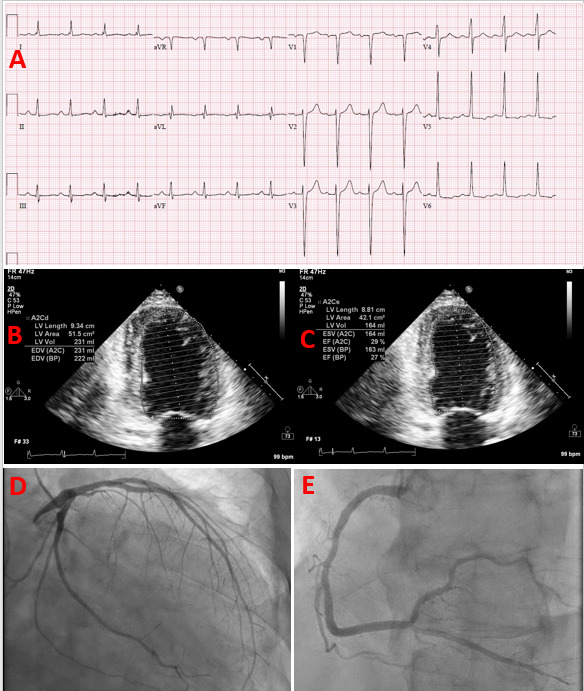 Figure 2. . Heart failure with reduced ejection fraction due to non-ischemic cardiomyopathy in a patient with uncontrolled type 2 diabetes.
