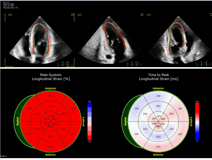 Figure 4. . Global longitudinal strain by speckle tracking echocardiography.