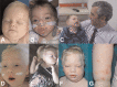 Figure 1. . Distinctive facial features in EPG5-related disorder.