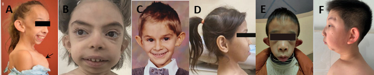 Figure 1. . Craniofacial features of several children with MBTPS1-related spondyloepimetaphyseal dysplasia with elevated lysosomal enzymes.