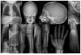 Figure 3. . Radiographs of a child with MBTPS1-related spondyloepimetaphyseal dysplasia with elevated lysosomal enzymes, age 37 months, with diffuse osteopenia; ovoid lumbar vertebral bodies; irregular aspect of cervical vertebral bodies, with mild reduction of vertebrae height; metaphyseal and epiphyseal irregularities of the long bones; mild metaphyseal enlargement; small epiphysis of the tubular bones; and copper-beaten skull.