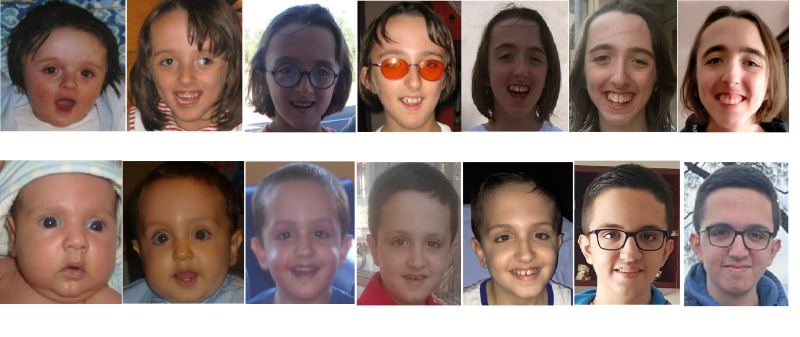 Figure 1. . Clinical features of individuals with Malan syndrome at different ages, with evolving facial appearance.