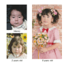 Figure 1. . Female at infancy, age two years, and age eight years with Kagami-Ogata syndrome due to a maternally inherited microdeletion of DLK1, MEG3/DLK1:IG-DMR, MEG3:TSS-DMR, MEG3, RTL1/RTL1as, MEG8, and a centromeric part of the snoRNA genes.