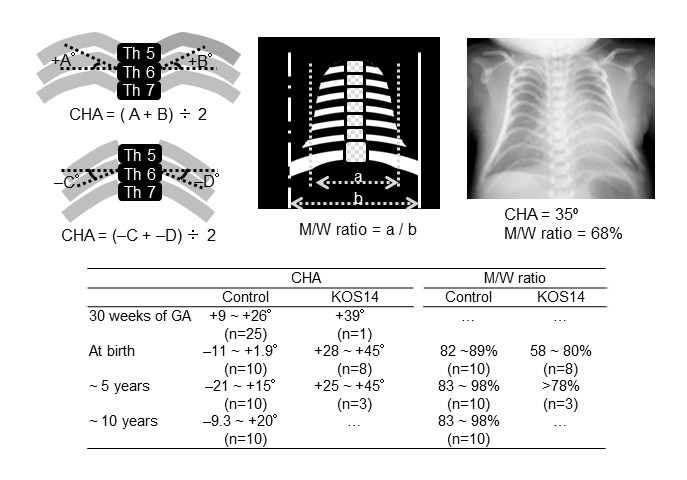 Figure 2. . Chest radiograph of a Japanese neonate with Kagami-Ogata syndrome.