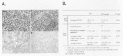 Figure 9. Decreased tumor vessels after long-term treatment with exogenous maspin protein.