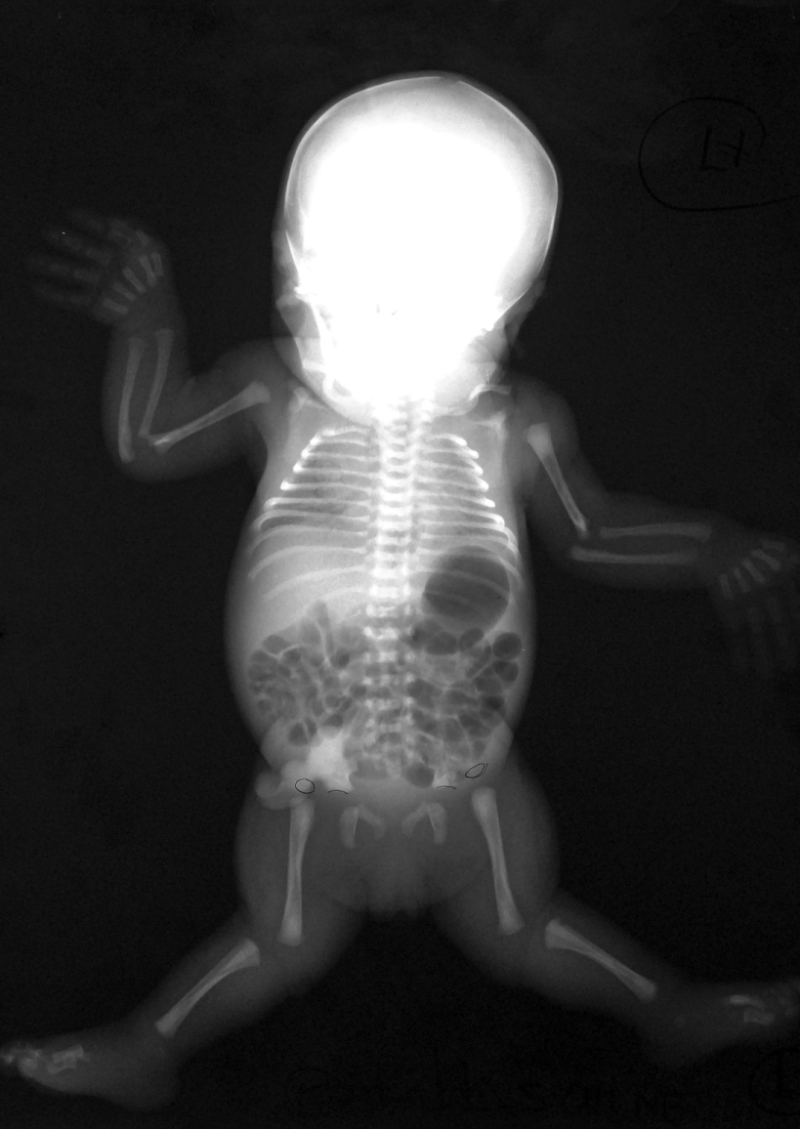 Figure 1. . A newborn with chondrodysplasia with congenital joint dislocations, CHST3-related.