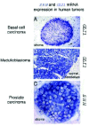 Figure 5. Consistent expression of SHH-GLI pathway components in sporadic human tumors: basal cell carcinoma, medulloblastoma and prostate carcinoma.