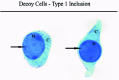 Figure 1. Urine cytology specimen with classical decoy cells (type 1) showing homogenous, amorphous, ground-glass like intranuclear inclusion bodies (arrows) in the central portion of the nuclei (N).