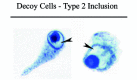 Figure 2. Type 2, “CMV-like” decoy cells showing central, intranuclear viral inclusion bodies surrounded by irregular and incomplete (intranuclear) halos (arrows).