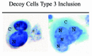 Figure 3. Type 3 decoy cells showing a granular chromatin pattern and multinucleation (N), cytoplasm (C).