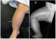 Figure 2. . Clinical photograph and radiograph of male age two months with COL1A1 pathogenic variant p.